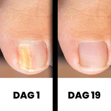 Afbeelding in Gallery-weergave laden, DermaNail - Gepatenteerde nagelschimmeltherapie – voor gezonde nagels binnen 4 weken
